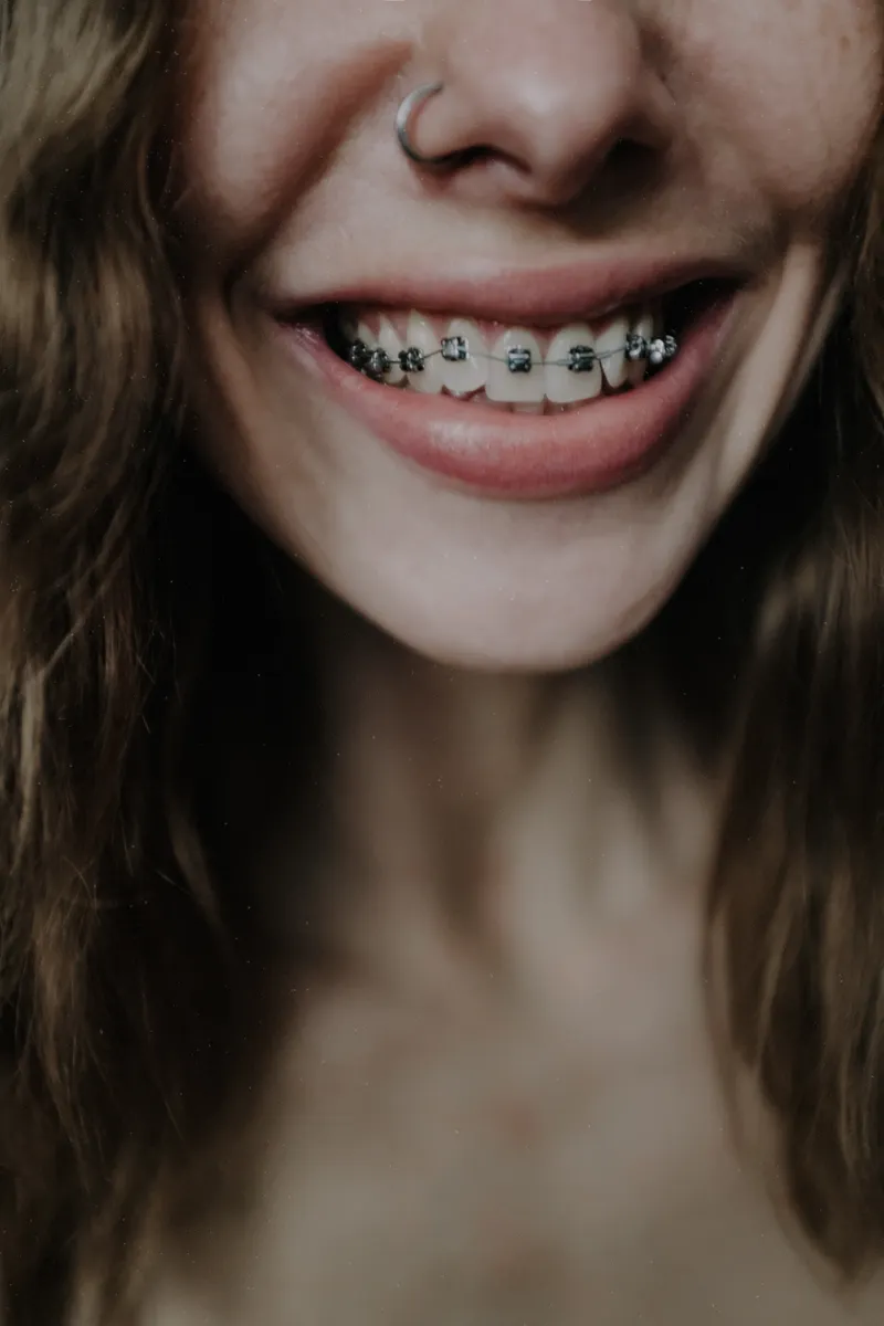 Close-up of a smiling mouth with metal braces on the teeth