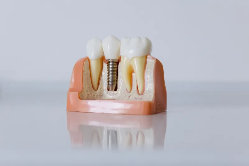 A model showing a dental implant: a small screw in the jaw with a tooth on top